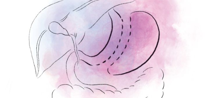 Sleeve Gastrectomy