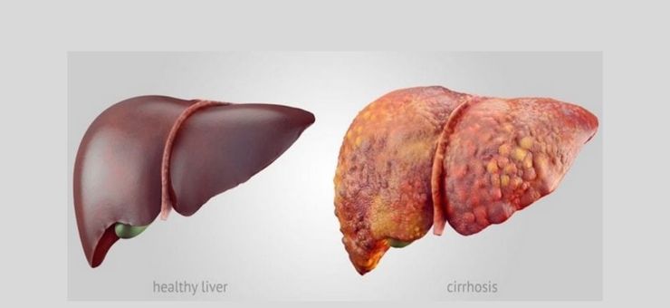 Non-alcoholic fatty liver disease (NAFLD)